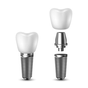 Alternative to Dental Implants